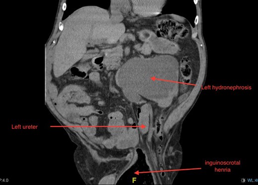 Coronal section of CT demonstrating severe left-sided hydronephrosis and left ureter compressed distally by hernia. Left distal ureter is closely related to neck of hernia sac at the deep ring.