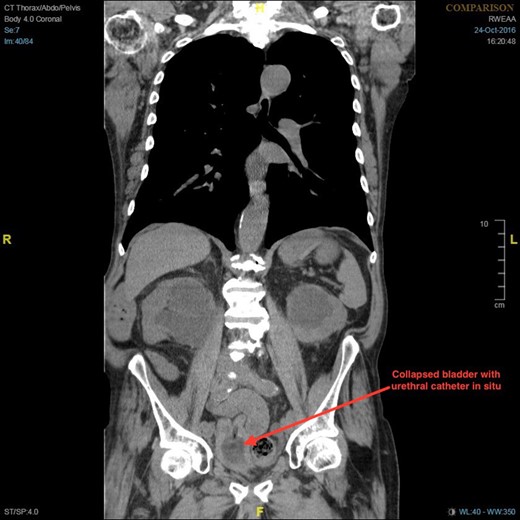 Coronal section of CT demonstrating bilateral hydronephrosis and collapsed bladder with urethral catheter in situ.
