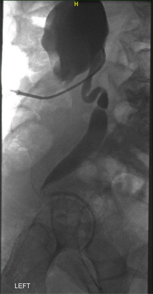 Left nephrostogram demonstrating tapering of the left ureter in the pelvis.