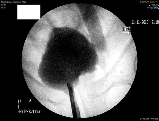 Cystogram suggesting no bladder involvement in hernial sac.