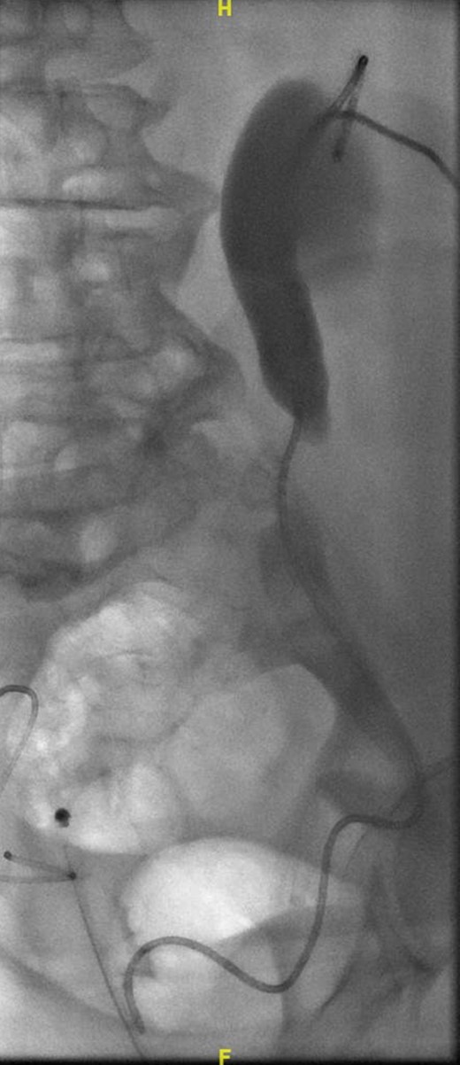 Left anterograde stent insertion into a tortuous ureter.