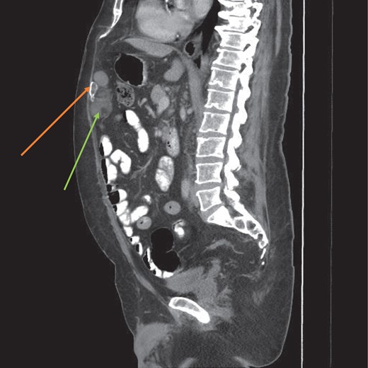 CT scan sagittal view of the myelolipoma (green arrow) with a calcified component (orange arrow).