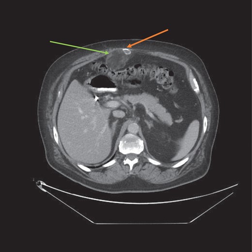 CT scan axial view of the myelolipoma (green arrow) with calcification (orange arrow). Abdominal wall musculature is intact thereby excluding an incisional hernia.