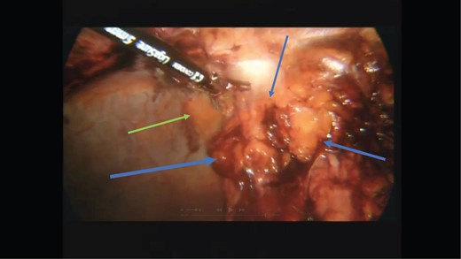 Laparoscopic view of the lesion (blue arrows) on the anterior abdominal wall (green arrow).