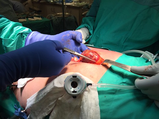 Exteriorization of the tumour at laparotomy.