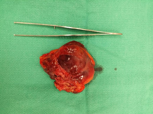 Gross pathological specimen post excision.