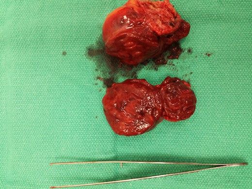 Cut section of the specimen with tumour heterogeneity.