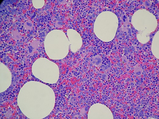 Histology slide showing the mature adipocytes and trilineage haematopoetic cell lines confirming the diagnosis of a myelolipoma.