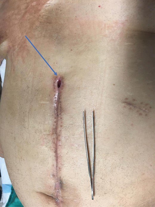 Post-operative wound dehiscence (blue arrow).