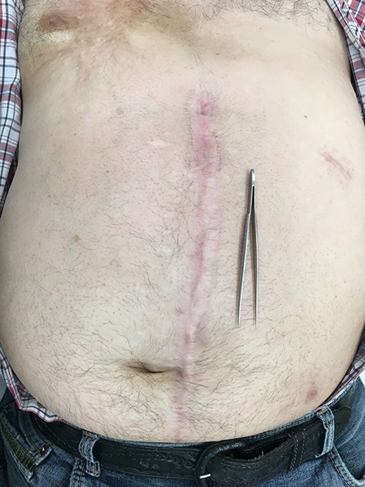 Complete wound healing 3 months after surgery.