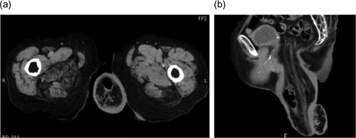 Pelvic computed tomography image. Full-thickness prolapse of redundant rectosigmoid colon from the anus is observed. (a) Axial section and (b) sagittal section.