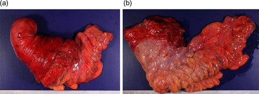 Resected specimen. The resected rectosigmoid colon was >30 cm long. (a) Before reduction and (b) after reduction.