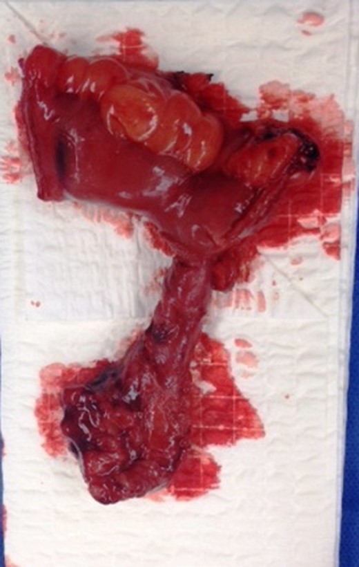 Resected Meckel’s Diverticulum.