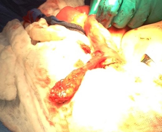 Meckel’s Diverticulum.