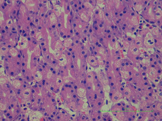 Gastric mucosa in Meckel’s diverticulum, no signs of ulceration where found.