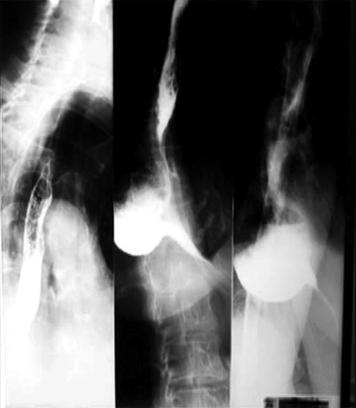Preoperative barium swallow. The preoperative barium swallow images showing a 10 × 8 cm diverticulum whose 4 cm wide neck was situated ~5 cm from the carina.