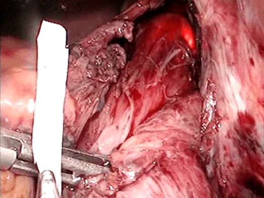 Gastroscopic guidance. This was needed for orientation within the mediastinum.