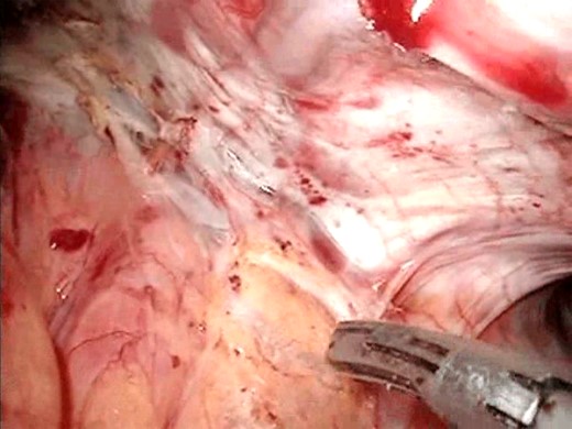 Dividing the diaphragmal crura.