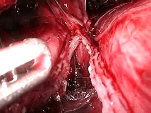 Resecting the diverticulum. The diverticulum was resected with a gastrointestinal stapler.