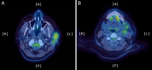 Axial PET scans (A and B) showing increased uptake of the left parotid gland and enlarged left-sided lymph nodes in the neck.