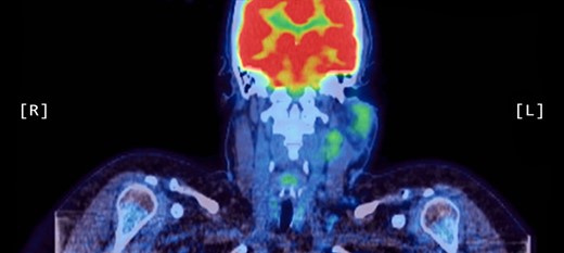 Coronal PET scan showing increased uptake of the left parotid gland and enlarged left-sided lymph nodes in the neck.