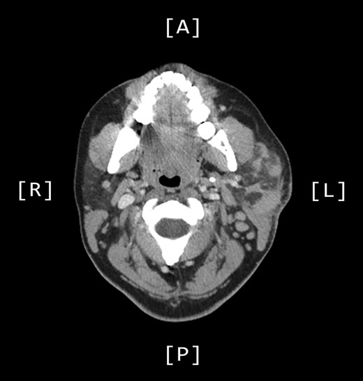 Axial CT sinuses (with contrast) showing left parotid multifocal soft tissue abnormality and enlarged left-sided cervical lymph nodes.