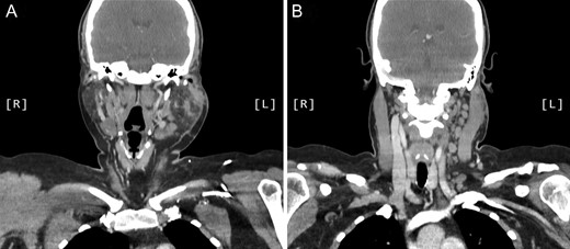 Coronal CT sinuses (with contrast) showing left parotid multifocal soft tissue abnormality (A) with enlarged left-sided cervical and superficial supraclavicular fossa lymph nodes (B).