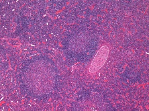 Histological examination of the parotid gland demonstrating diffuse lymphoid infiltrate with prominent follicular hyperplasia and well developed mantle zones (haematoxylin and eosin stain, ×2.5).