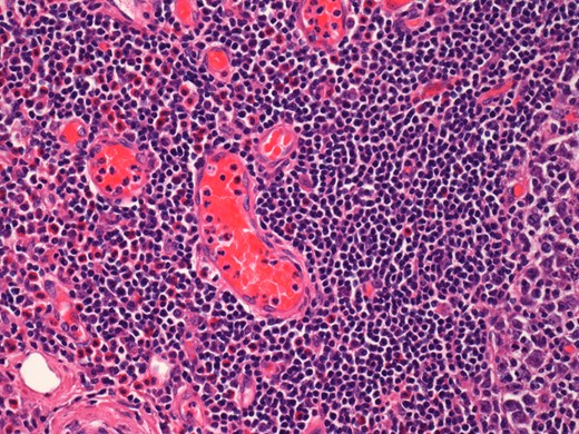 Histological examination of the parotid gland demonstrating eosinophil-rich mixed inflammatory cell infiltrate. Prominent hyalinization of the sinusoidal vessels with thick collagen bundles within the surrounding stroma can be observed (haematoxylin and eosin stain, ×20).