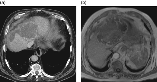 Preoperative CT-scan (a) and MRI (b) of the liver showing hypervascularized hepatic lesions with central necrosis and associated hematoma.
