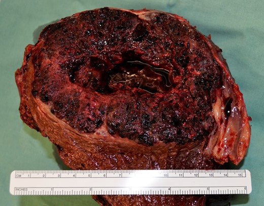 Intraoperative liver specimen showing the large tumor (divided on the back table).