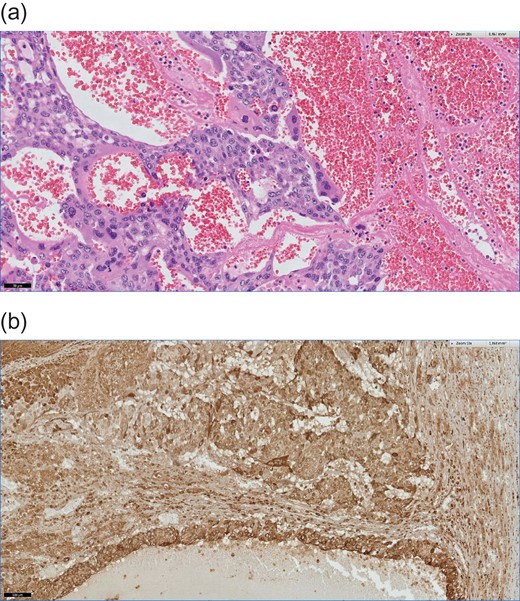 (a) Formaline-embed sections, Hematoxylin eosin (HE) staining, ×200.This photomicrograph shows an extensive hemorrhage and typically features of a choriocarcinoma. The tumor composed of mononucleate cytotrophoblasts and multinucleate syncytiotrophoblasts. (b) Formaline-embed sections, immonhistochemical (IHC) staining using anti-ß-hCG antibodies, ×100. The tumor cells are diffusely positive for ß-hCG.