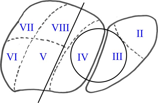 Liver diagram showing lesion (circle) and resection line (Segments I–VI were resected).