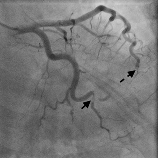 Coronary angiography showed obstructed distal left anterior descending artery (dotted arrow) and distal left circumflex artery (solid arrow).