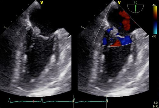 2D transesophageal echocardiogram showing a thickened mitral valve with vegetation that can be seen on the anterior mitral valve leaflet. Image on the right is a color flow Doppler view showing no mitral regurgitation and stenosis.