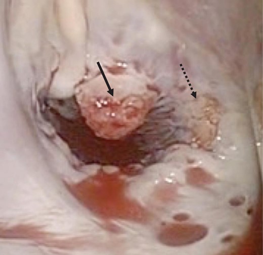 Intraoperative photograph showing verrucous vegetations on the mitral valve of A2 (solid arrow) and A3 (dotted arrow).