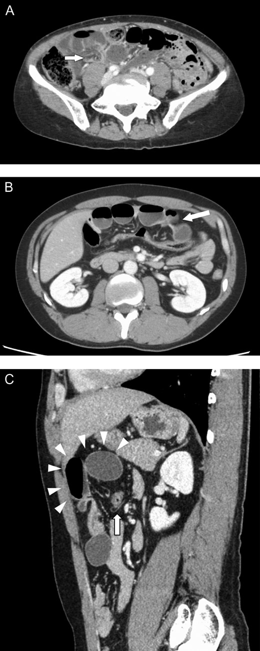 Enhanced abdominal computed tomography findings. (A) The beak sign (arrow) is indicated in the lower right quadrant. (B) Small bowel loops with caliber change (arrow) are indicated in the upper abdomen. (C) A peripheral herniated loop (arrowheads) within the peritoneal cavity. The transverse colon is indicated by an arrow.