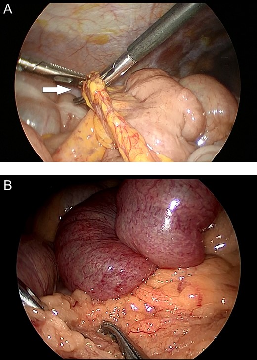 Intraoperative images. (A) Incarceration of a loop of the small bowel through a defect in the greater omentum (arrow). (B) Small bowel loops appear to be congested and herniate through the greater omentum.