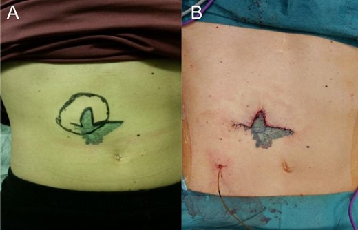 (A) The abdominal tattoo before the operation and the tumour is beneath it. (B) Surgical scar along the margin of the tattoo.