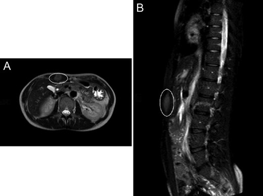 (A) Abdominal CT showing the desmoid tumour within the abdominal wall. (B) Abdominal CT scan showing lateral view of the desmoid tumour.