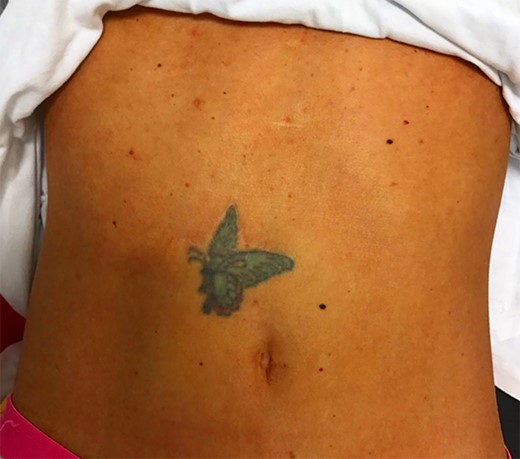 The surgical scar at 2-year follow-up.