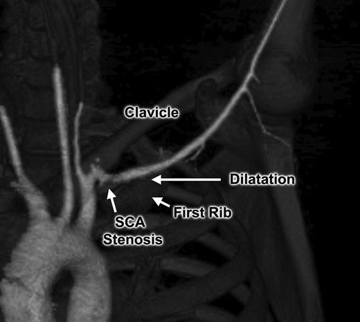 Computed tomography angiogram with 3D reconstruction, demonstrating focal left subclavian artery (SCA) stenosis and post-stenotic dilatation within the thoracic outlet.