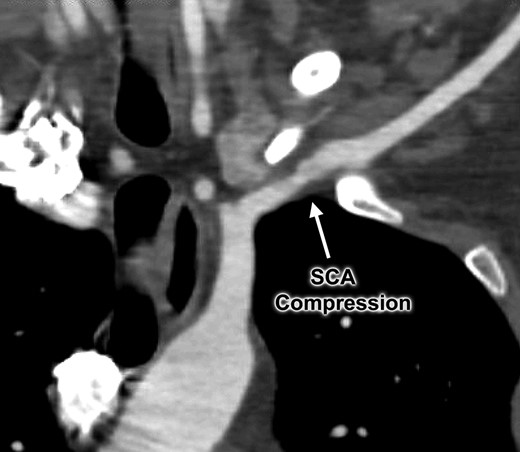 Computed tomography angiogram demonstrating focal area of left subclavian artery (SCA) compression between the first rib and clavicle.