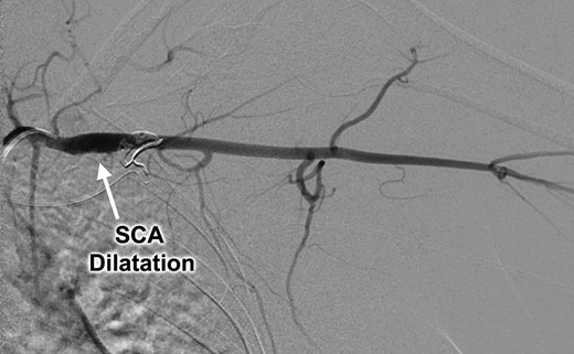 Catheter-based left subclavian arteriogram demonstrating post-stenotic aneurysmal dilatation of the subclavian artery (SCA).