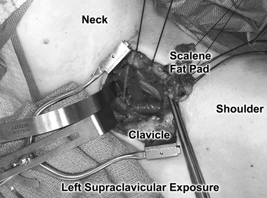 Operative photograph demonstrating initial exposure of the left supraclavicular space, with the scalene fat pad mobilized and rotated laterally. The subclavian artery was found in the costoclavicular space in front of the anterior scalene muscle.