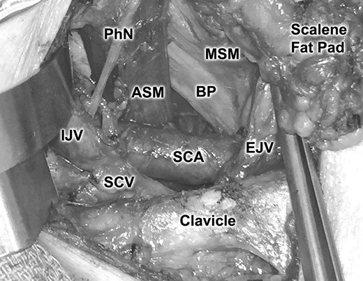 Close-up view of the subclavian artery and related structures. ASM, anterior scalene muscle; BP, brachial plexus; EJV, external jugular vein; IJV, internal jugular vein; PhN, phrenic nerve; MSM, middle scalene muscle; SCA, subclavian artery; SCV, subclavian vein.