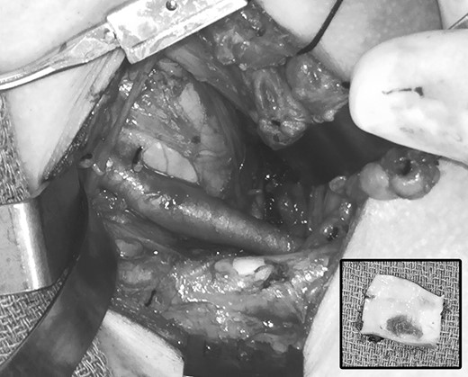 Operative photograph after thoracic outlet decompression, demonstrating area of post-stenotic dilatation in the left subclavian artery. Inset, excised segment of the affected left subclavian artery, demonstrating ulceration and thrombus on the luminal surface.