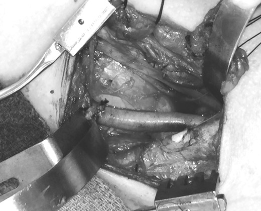 Operative view after reconstruction of the left subclavian artery with a cryopreserved femoral artery interposition bypass graft.