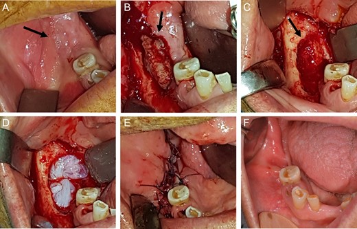 View of mandibular alveolar process in patient 1: (A) preoperative BRONJ affected area; (B) fistula, (C) curetted area, (D) HAM application, (E) suture of mucosal soft tissues and (F) postoperative follow-up after a period of 180 days.