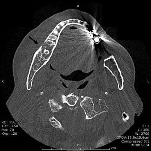 Preoperative occlusal X-ray of mandible of patient 1.
